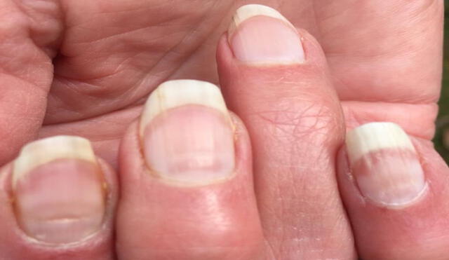 Los surcos horizontales o, como fueron acuñadas, las 'uñas COVID' no están comprobadas como síntomas de la COVID-19. Foto: Twitter