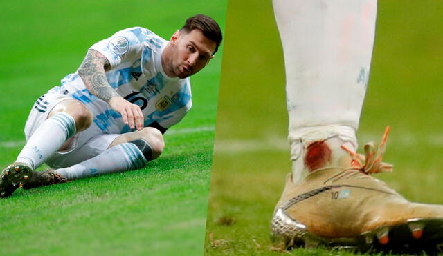 Así quedó el tobillo de Lionel Messi tras el encuentro ante Colombia. Foto: Composición LR / EFE