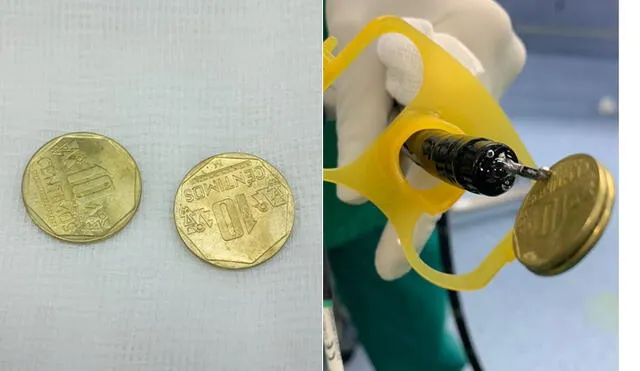 Dos monedas de 10 céntimos se comió un niño y le fueron extraídas en el hospital. Foto: EsSalud
