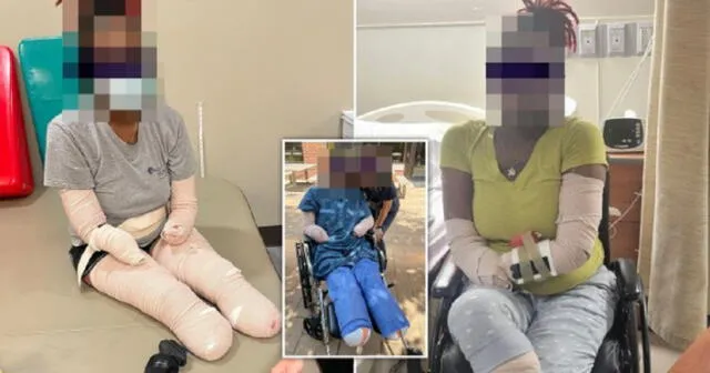 El Dr. Wesley Ely publicó imágenes de su paciente que perdió las manos y los pies. Foto: Wesley Ely/Twitter