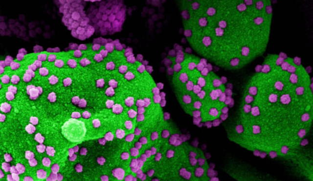 Célula humana infectada con partículas del virus SARS-CoV-2 (de color púrpura). Foto: Instituto Nacional de Alergias / AFP