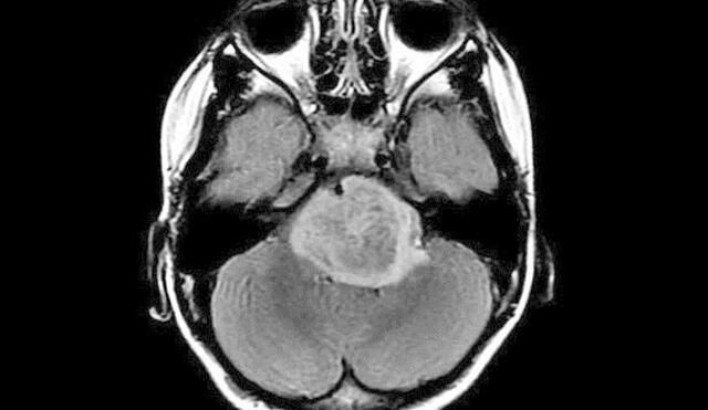 El glioma pontino intrínseco difuso es una enfermedad agresiva e incurable que afecta a niños. Foto: NINDS