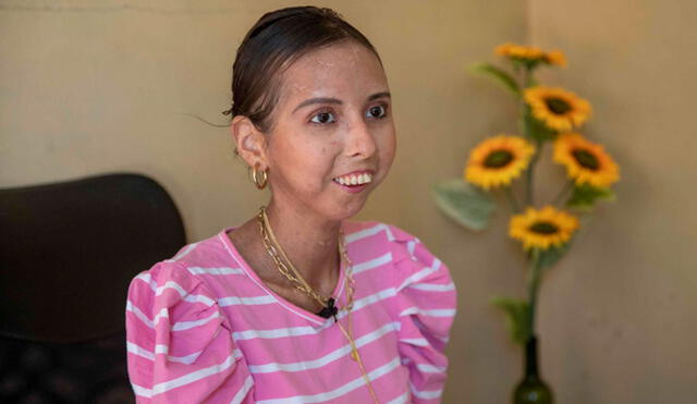 Nathaly Cerda fue diagnosticada con esclerodermia sistémica hace 13 años. Foto: EFE