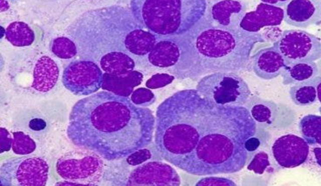 Mieloma múltiple con células plasmáticas de tamaño variable. Foto: Atlas del Grupo Español de Citología Hematológica