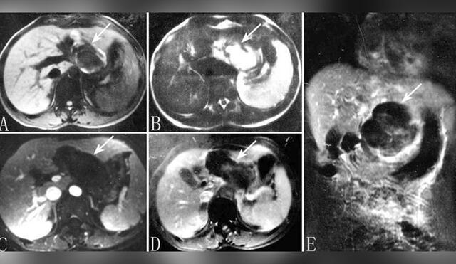 La resonancia magnética reveló el embarazo ectópico hepático. Foto: NCBI