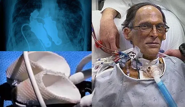 El paciente Craig Lewis había sido sometido a un ensayo de corazón artificial tras sufrir una infección cardiaca. Foto: Cinco Noticias / El corazón deja de latir