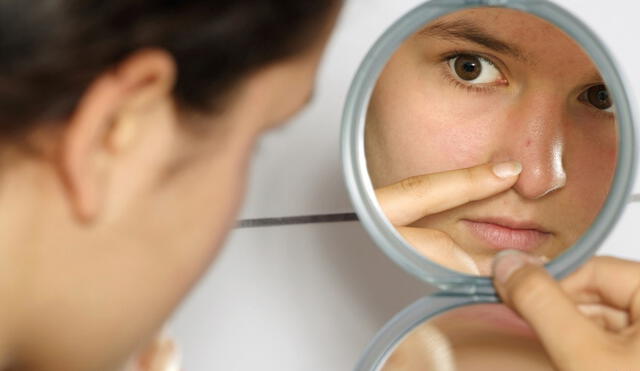 Los especialistas recomiendan, antes que nada, acudir a un dermatólogo para tratar el acné. Foto: Jibanez / El Popular