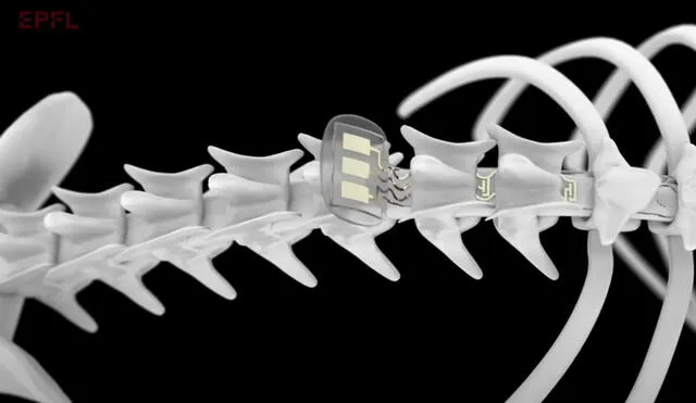 Los científicos insertaron un implante con 16 electrodos para que entren en contacto con la médula espinal. Imagen referencial: NeuroRestore