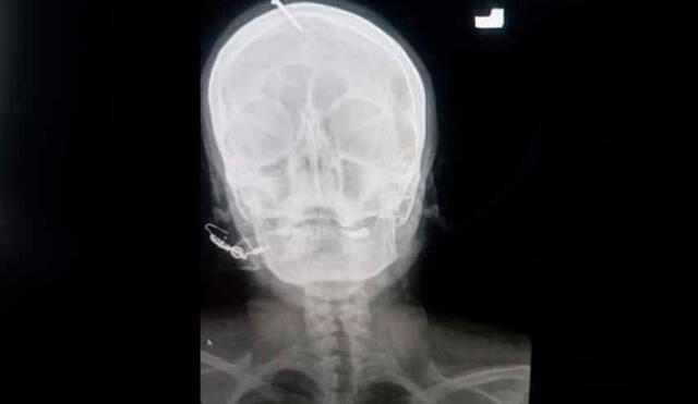 Una radiografía mostró que el clavo había sido incrustado 5 centímetros en el cráneo, sin llegar al cerebro. Foto: Twitter