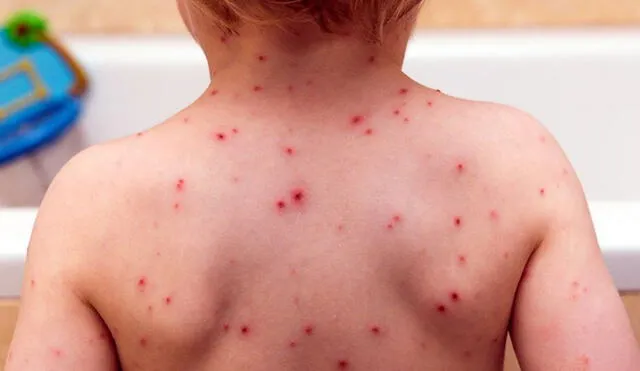 La varicela se da con mayor frecuencia en menores. No obstante, las personas adultas no están exentas a contraer la infección. Foto: El imparcial