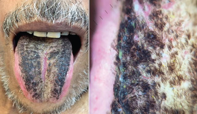 Las bacterias, los hongos y las partículas de comida atrapadas en los 'pelos de la lengua' determinan el color del área. Foto: Jama Networks