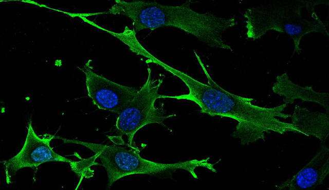 Células tumorales inducidas por la expresión de la versión mutante de RRAS2. Foto: EFE / Centro de Investigación del Cáncer español