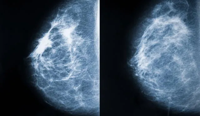 Comparación en rayos X entre un seno invadido por el cáncer (izquierda) y otro sano (derecha). Foto: Adobe Stock