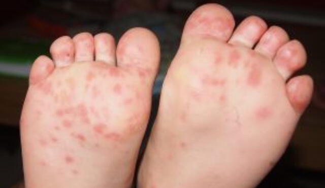 Cuatro regiones en alerta epidemiológica por brotes del virus coxsackie. FOTO: Instagram / Vital Health