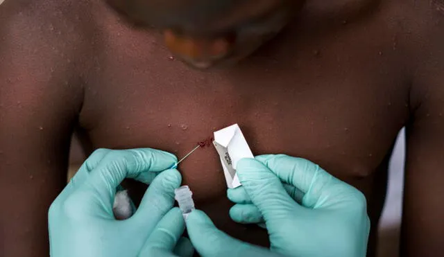 Diversos países de distintos continentes han reportado casos de viruela del mono (monkeypox). Foto: Melina Mara / The Washington Post