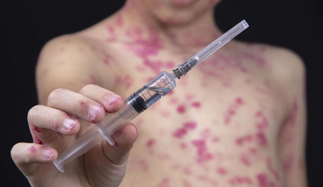 Conoce todos los detalles acerca de esta infección que se viene propagando a nivel mundial. Foto: AFP
