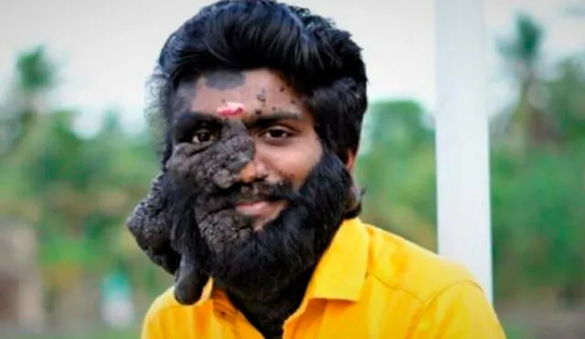 Prabhulal Prasannan tiene el 80% de su rostro cubierto con lunares. Foto: Instagram /Clarin