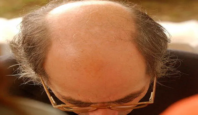 Baricitinib ha sido aprobado por la FDA como la primera píldora para el tratamiento de la alopecia areata severa en EE. UU. Foto: AFP