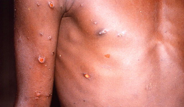 Este domingo 26 de junio, el ministro de salud del Perú informó sobre el primer caso confirmado de monkeypox. Foto: EFE