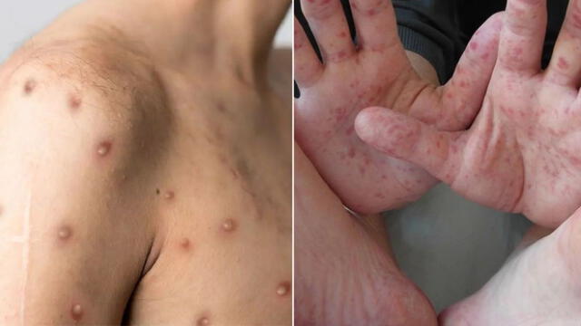 Para un adecuado seguimiento es importante diferenciar la viruela del mono de la enfermedad de manos, pies y boca. Foto: composición La República/El País/Vital Health
