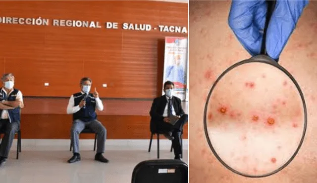La Diresa Tacna afirmó que se encuentran preparados para atender los casos de viruela del mono que se presenten. Foto: La República/archivo