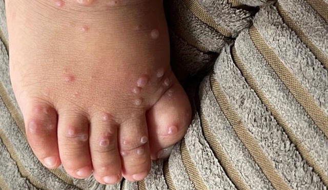 Erupciones cutáneas en un infante de 13 meses de edad, uno de los casos confirmados de "gripe del tomate". Foto: The Pediatric Infectious Disease Journal