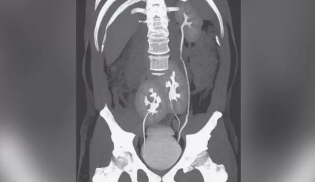 Una tomografía computarizada reveló un tercer riñón escondido en el cuerpo de un paciente brasileño de 38 años. Foto: The New England Journal of Medicine
