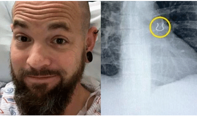 Joey Lykins fue sometido a una broncoscopía para removerle el piercing del pulmón izquierdo. Foto: Kennedy News and Media