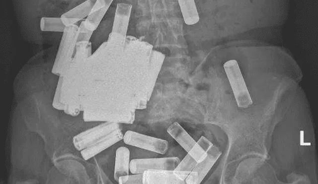 Una radiografía reveló las 55 baterías ingeridas y atascadas en el tracto gastrointestinal de la mujer. Foto: Irish Medical Journal