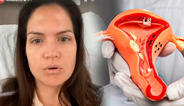 Lorena Álvarez fue sometida a cirugía tras diagnóstico de endometriosis. Foto: composición/LR/captura/Instagram