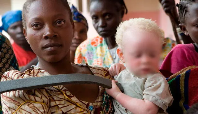 Amnistía Internacional advirtió que los albinos de Malawi están en riesgo de “extinción total”. Foto: referencial-Autopista