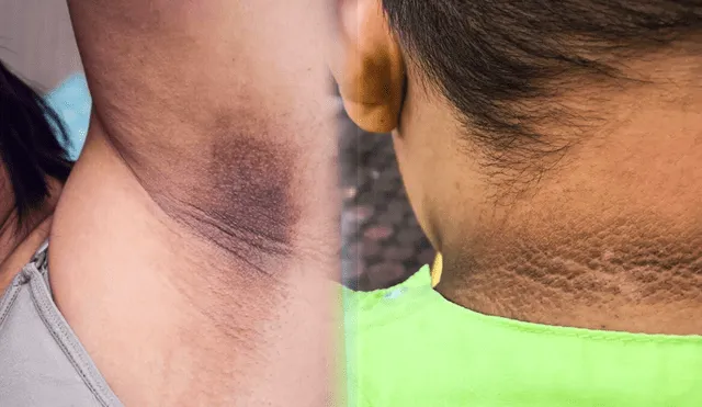 Las manchas negras en la piel están presentes en muchas personas y tienen diferentes causas. Foto: composición La República/Univisión