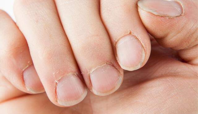 Los 'padrastros' son molestosos pellejos que suelen aparecer al lado de las uñas debido a la deshidratación de la piel. Foto: SaludOrg/Instagram