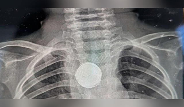Los médicos detectaron que el niño tenía una pila atascada en su esófago gracias a una radiografía. Foto: captura/Clarín