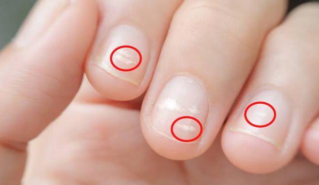Lo más recomendable es visitar a un médico dermatólogo en caso presentes este tipo de manchas en tus uñas. Foto: El periódico
