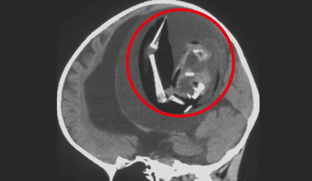 Tomografía computarizada de la cabeza de la bebé. Se resalta la ubicación del feto malformado. Foto: composición LRLi et al./Neurology