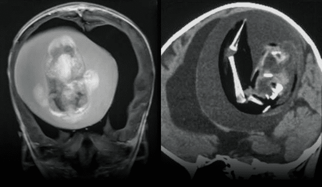 Radiografía del feto extraído de la cabeza de la menor. Foto: Neurology