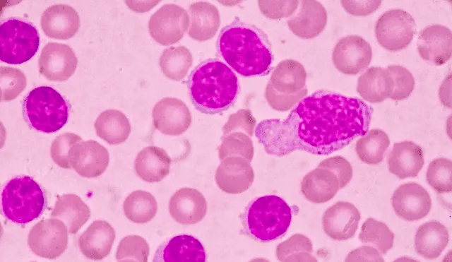 Células cancerosas en un paciente con leucemia mieloide aguda. Foto: Weill Cornell Medicine