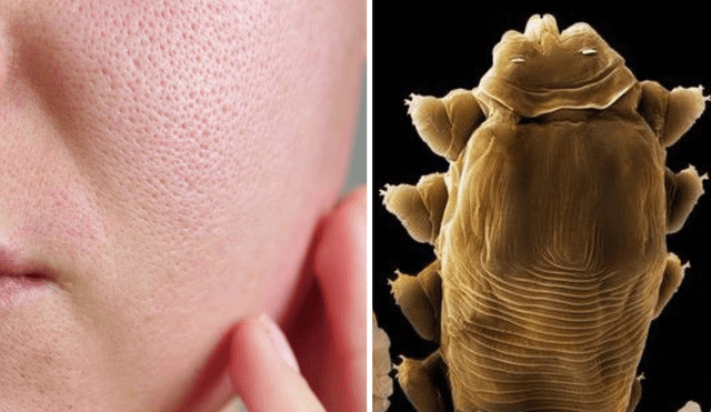 Los Demodex folliculorum, ácaros microscópicos que viven en nuestro rostro, salen de los poros para encontrar un nuevo folículo de piel, buscar pareja y aparearse. Foto: composición LR/Difusión/National Geographic