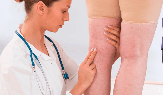Las várices en las piernas son producidas por una mala circulación sanguínea. Foto: Mejor con salud
