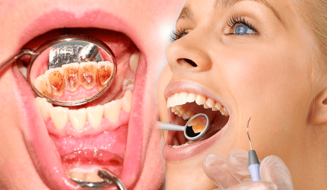 Descubre cómo reducir los niveles de sarro en tus dientes de manera natural. Foto: composición/Semana/Rob Dental