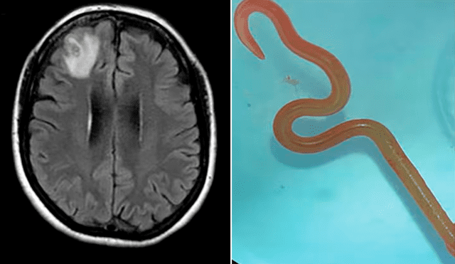 El gusano era un Ophidascaris robertsi, que estaba vivo en el cerebro de la mujer. Fotos: Camberra Health