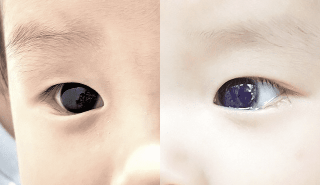 Los ojos del bebé cambiaron de color marrón oscuro a azul tras ser tratado con favipiravir. Foto: Frontiers in Pediatrics