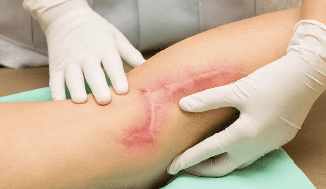 Una cicatriz puede tardar hasta 18 meses en desaparecer, por lo general. Foto: Medline Plus