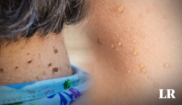 Los lunares de carne son pequeños tumores benignos que aparecen en ciertas partes de la piel. Foto: composición LR//AFP/Advance Dermatology