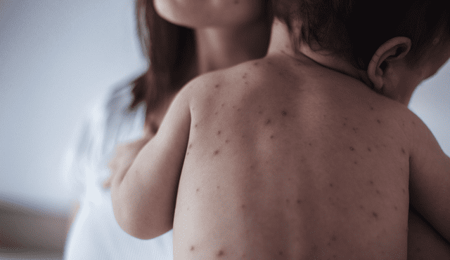 Los menores de edad son los más vulnerables ante el sarampión. Foto: Health Journal