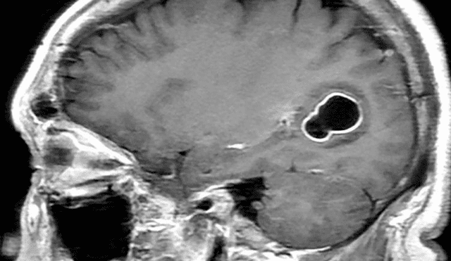 En esta imagen, se observa la lesión que causa la tenia de cerdo en el cerebro. Foto: SCIENCE PHOTO LIBRARY