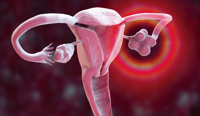 El cáncer de ovario se trata mejor cuando se detecta a tiempo. Foto: difusión