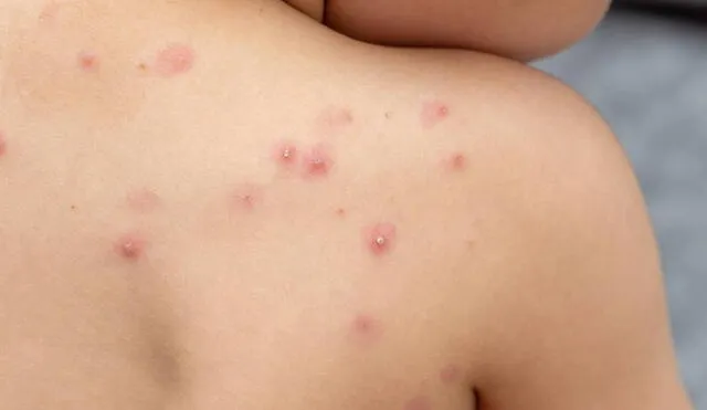 El brote de granos o ampollas en la piel son algunos de los primeros síntomas de mpox. Foto: difusión