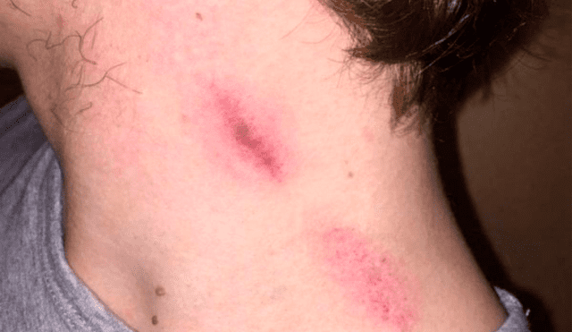 Los chupetones en el cuello puede desencadenar en enfermedades como herpes. Foto: difuasión